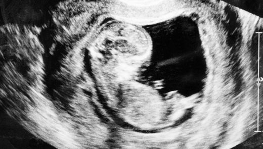 O que fazer se você já teve um aborto espontâneo?