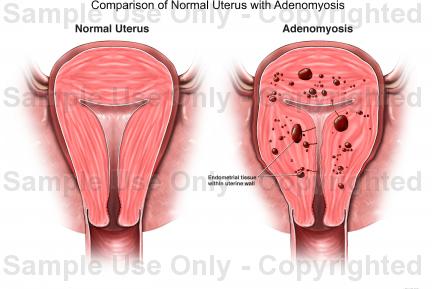 adenomyosis